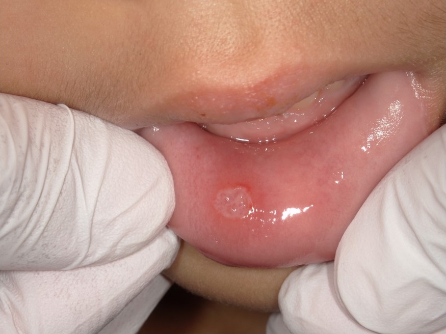 アフタ性口内炎